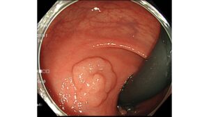 症例提示：大腸ポリープ切除テクニック（２ｃｍ以上のLST；側方発育型腫瘍）