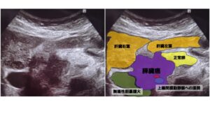 背部痛を主訴にエコーで発見した膵臓癌の一例