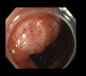 カンピロバクター腸炎の一例