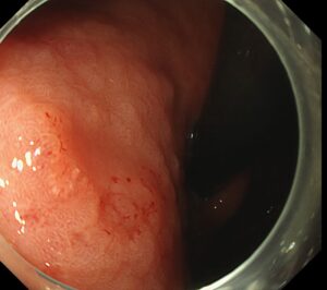 穿通性胃潰瘍後の潰瘍瘢痕上に発生した早期胃癌に対して内視鏡切除した一例