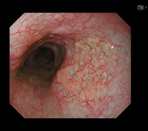 極めて稀な食道異所性胃腺の一例