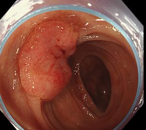 便潜血反応陰性、進行大腸癌の２例