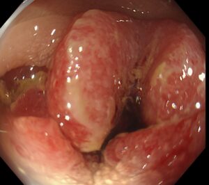 １ヶ月前から便秘と下痢を繰り返し出現した進行大腸癌の一例