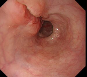 胸部つかえ感、背部痛で発見した進行食道癌の一例